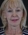 Face Lift Patient 23 - Before Thumbnail 