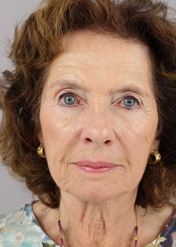 Face Lift Patient 24 - Before Thumbnail
