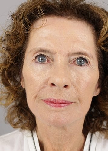 Face Lift Patient 24 - After Thumbnail