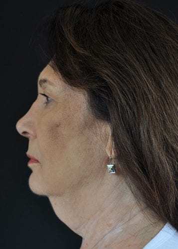 Face Lift Patient 26 - Before 
