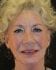 Face Lift Patient 29 - After Thumbnail 