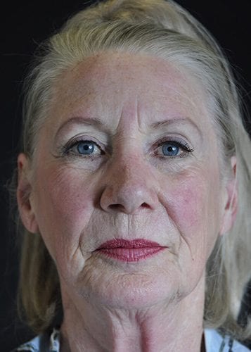 Face Lift Patient 29 - Before 