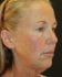 Face Lift Patient 30 - Before Thumbnail 