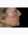 Face Lift Patient 31 - Before Thumbnail 