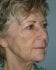 Face Lift Patient 31 - Before Thumbnail 