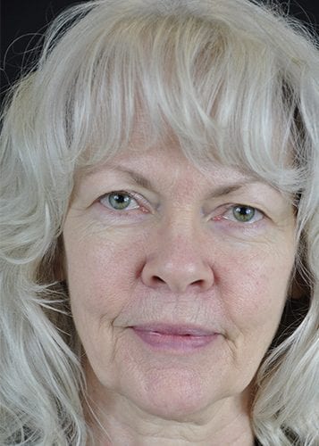 Face Lift Patient 06 - Before Thumbnail