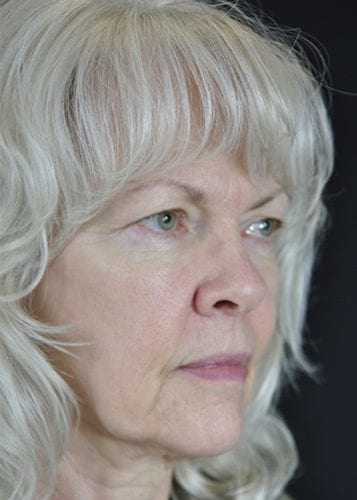 Face Lift Patient 06 - Before 