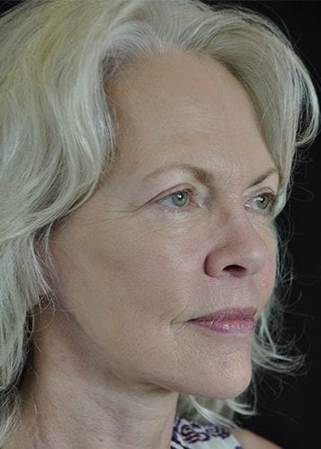Face Lift Patient 06 - After 