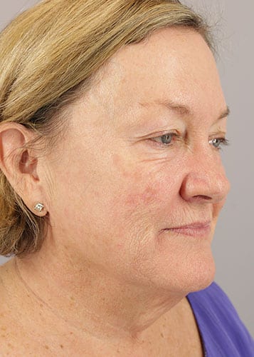Face Lift Patient 35 - Before 