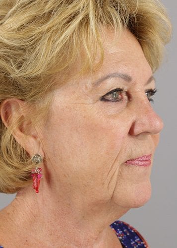 Face Lift Patient 34 - Before 