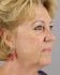 Face Lift Patient 34 - Before Thumbnail 