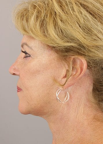 Face Lift Patient 34 - After 