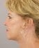 Face Lift Patient 34 - After Thumbnail 