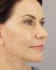 Face Lift Patient 36 - After Thumbnail 