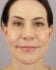 Face Lift Patient 36 - After Thumbnail 