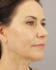 Face Lift Patient 36 - Before Thumbnail 