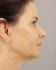 Face Lift Patient 36 - Before Thumbnail 