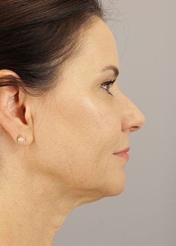 Face Lift Patient 36 - Before 