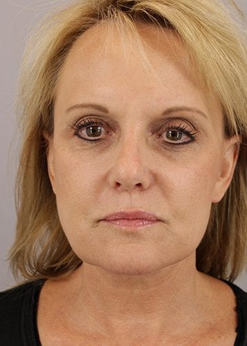Face Lift Patient 08 - After Thumbnail