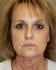Face Lift Patient 08 - Before Thumbnail 