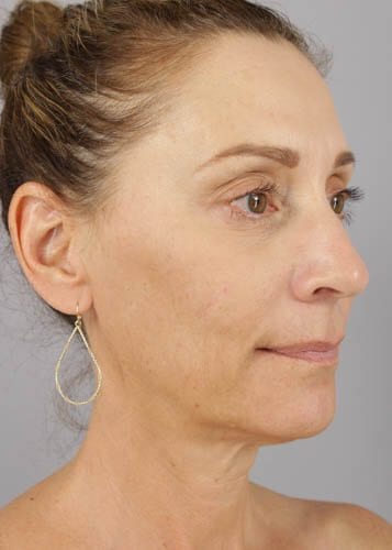 Face Lift Patient 02 - Before Thumbnail