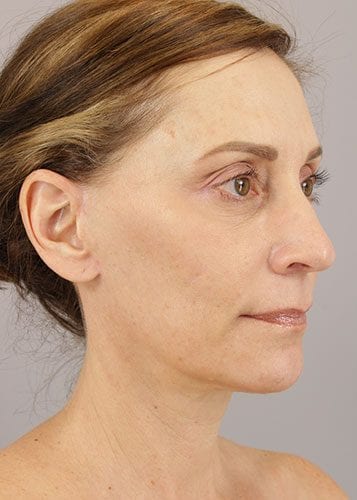 Face Lift Patient 02 - After Thumbnail