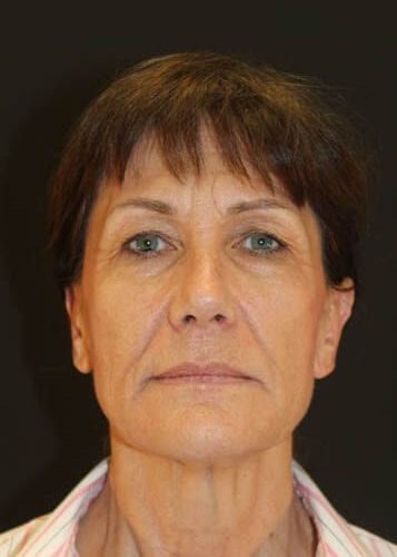Face Lift Patient 03 - Before Thumbnail
