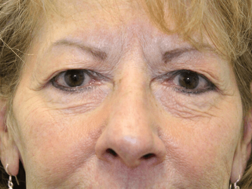 Blepharoplasty Patient 06 - Before Thumbnail