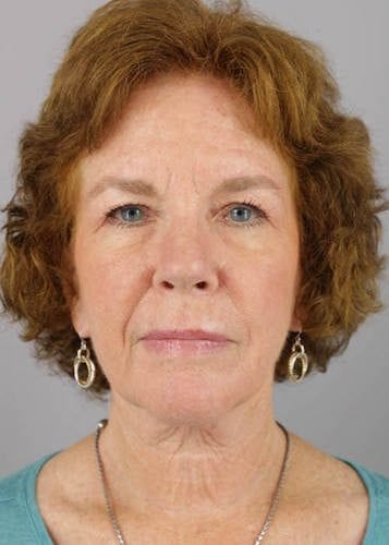 Face Lift Patient 01 - Before Thumbnail