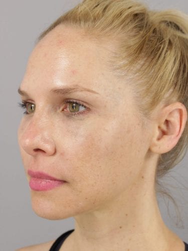 Facial Injections 01 - After 