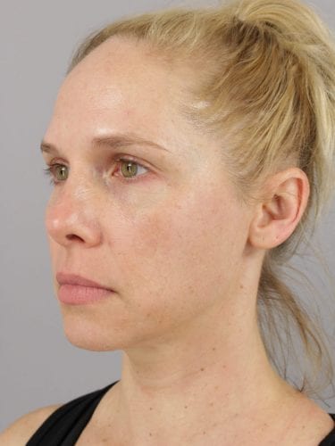 Facial Injections 01 - Before 