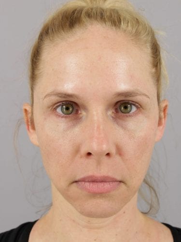Facial Injections 01 - Before 