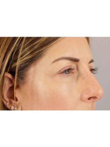 Facial Injections 03 - After 