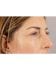 Facial Injections 03 - After Thumbnail 