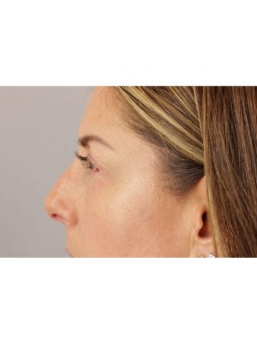 Facial Injections 03 - After 