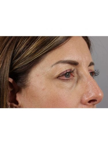 Facial Injections 03 - Before 