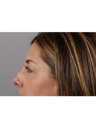 Facial Injections 03 - Before 