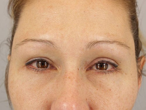 Fat Transfer Patient 01 - After 