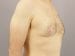 Gynecomastia Patient 04 - After Thumbnail 