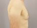 Gynecomastia Patient 04 - Before Thumbnail 