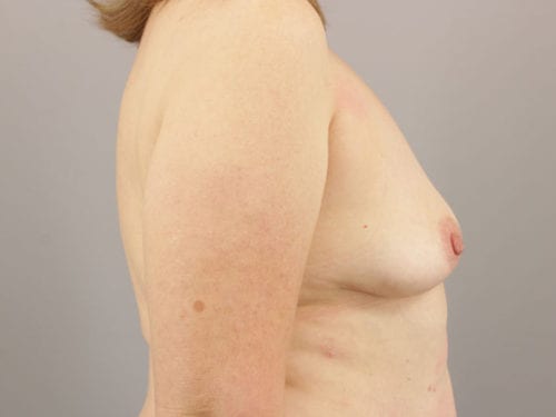 Implant Removal 03 - After 