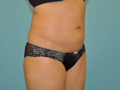 Liposuction Patient 01 - After Thumbnail