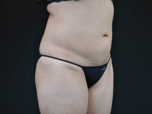 Liposuction Patient 01 - Before Thumbnail
