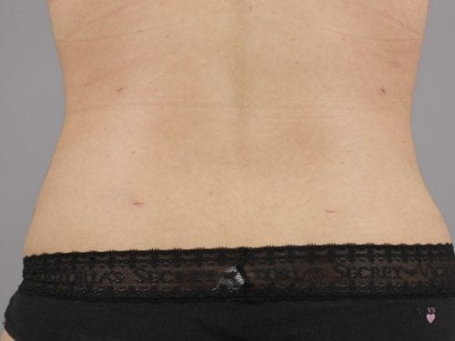 Liposuction Patient 10 - After Thumbnail