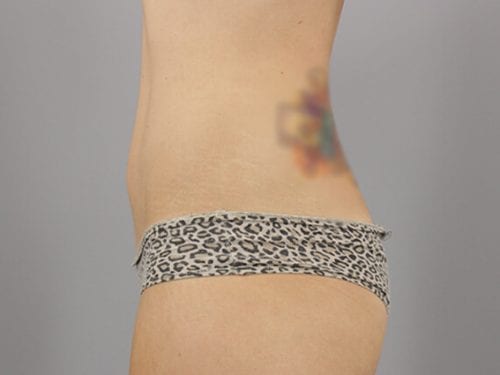 Liposuction Patient 02 - After Thumbnail
