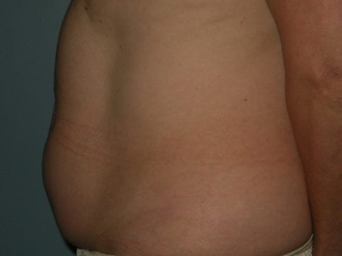 Liposuction Patient 09 - Before Thumbnail