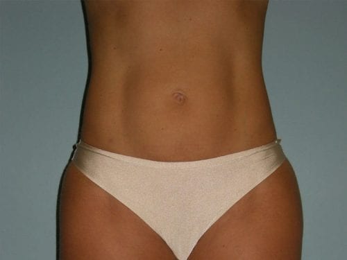 Liposuction Patient 03 - After Thumbnail