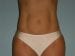 Liposuction Patient 03 - After Thumbnail 