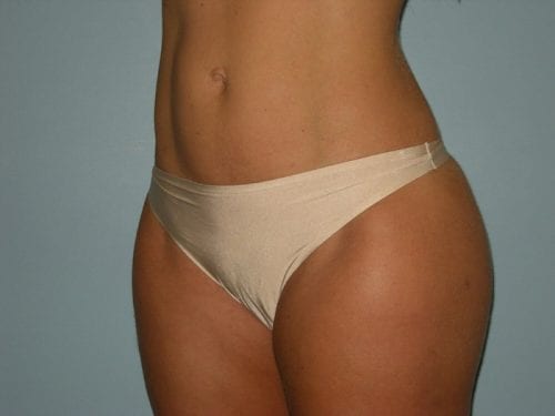 Liposuction Patient 03 - After 