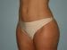 Liposuction Patient 03 - After Thumbnail 